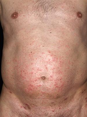Itch in <mark class="highlighted">Scabies</mark>—What Do We Know?